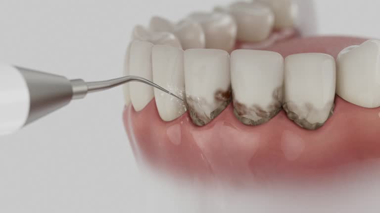 Trusted Wisdom Tooth Removal service in Lawrence, KS - Dentist Open Now